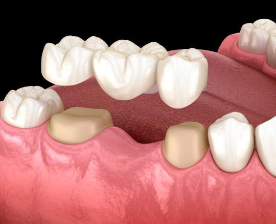 Dental bridge model showing replacement teeth on gum tissue with adjacent natural teeth.