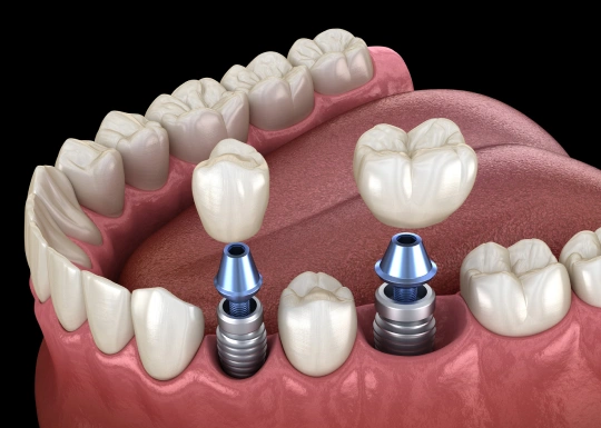 Dental implant diagram showing tooth replacement procedure with implant posts and crowns in gum model.