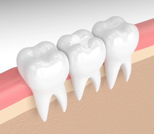Four white teeth with roots embedded in pink gum tissue and beige jawbone illustration.