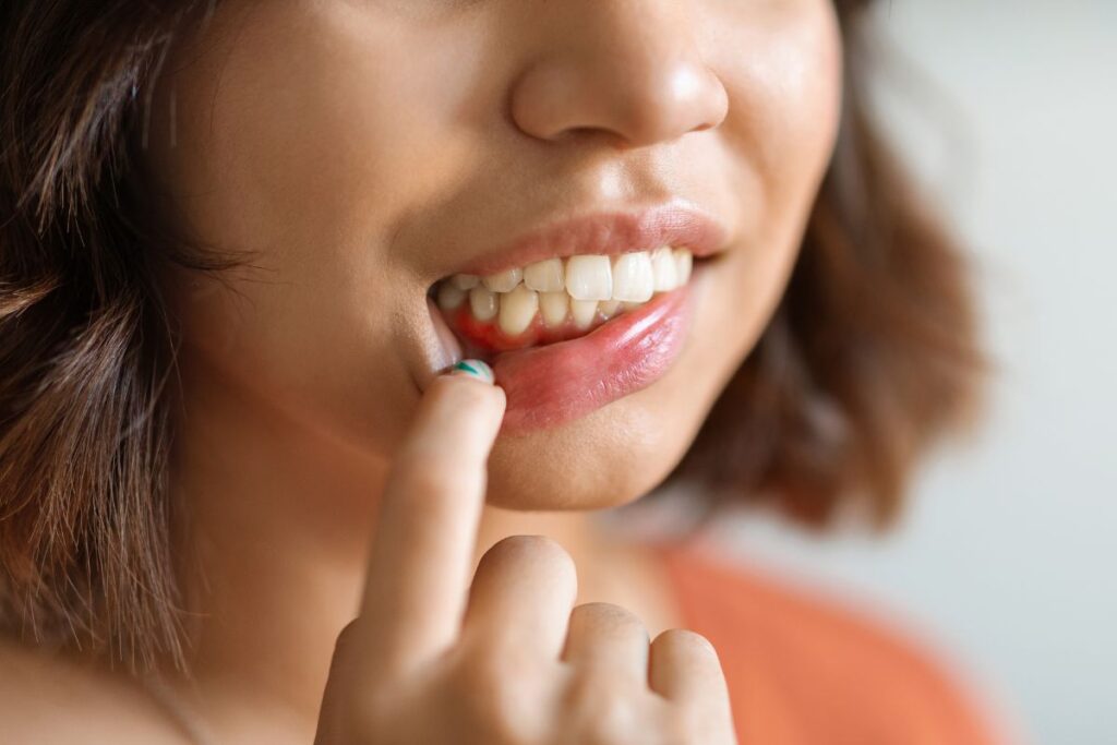 Close-up of swollen and red gums around a tooth, showing a common early sign of gum disease and gum inflammation.